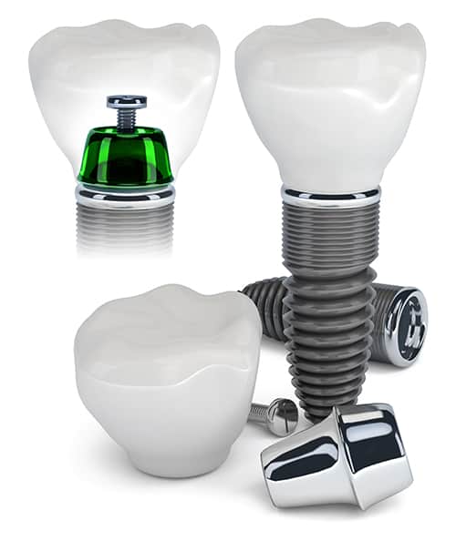 Dental Implants - Campus Dentist
