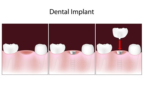 Dental Implants - Campus Dentist