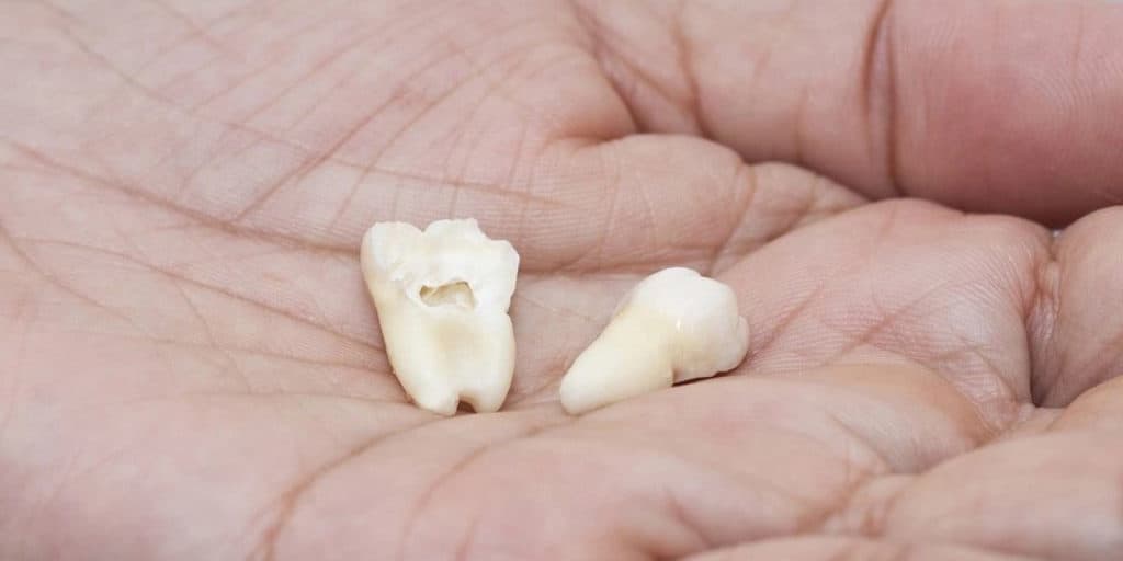 extractions with wisdom tooth removal - Campus dentist